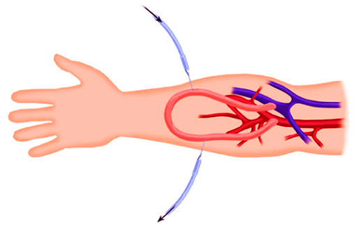 انجام دیالیز